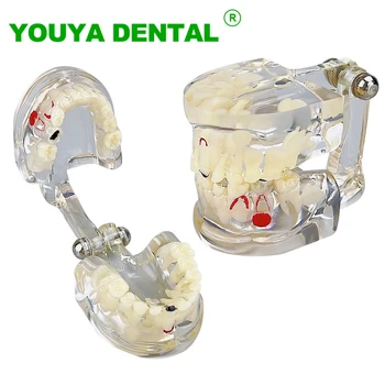 Модель зубов У детей, первичные и постоянные зубы, альтернативная модель с кариесом, Стоматологическая патология, модель стоматологических инструментов